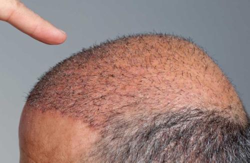 Zaboravite na prorjeđivanje kose: Ovo otkriće mijenja pravila igre