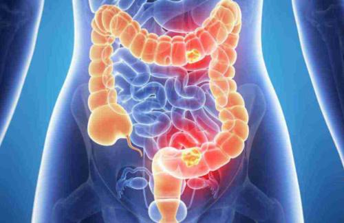 Zatvor, crijevna blokada, bolovi u trbuhu, mučnina? Kako ih se rije&scaron;iti u 24 sata!